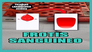 🩸¿Como Hacer un FROTIS SANGUÍNEO Extendido de Sangre Periférica 🔬Tutorial Laboratorio Clínico [upl. by Meridel]