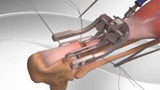 Achilles Tendon Rupture Repair with Arthrex® PARS System [upl. by Orin]