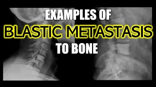 Examples of Blastic Metastasis to Bone doctor cancer bones [upl. by Quentin]