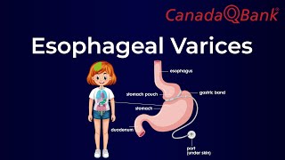 Esophageal Varices [upl. by Vevay]