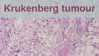 What is a Krukenberg tumour  Pathology mini tutorial [upl. by Aisad]