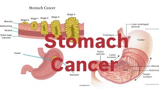 STOMACH CANCER Definition Riskfactors symptoms stages treatmentprevention nursing diagnosis [upl. by Ayital]