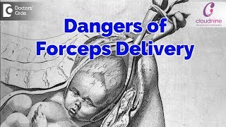 Is Forceps Delivery dangerous  Dr Sahana Hedge of Cloudnine Hospitals  Doctors’ Circle [upl. by Phalan]