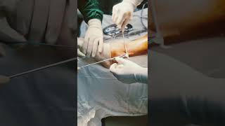 Cruciate ligament repair ligament surgery  mozart peroneus longus [upl. by Cheke]