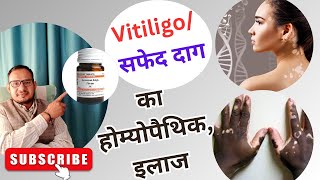 Vitiligo treatment त्वचा पर सफेद दाग का इलाज  white patches  Leucoderma treatment skin sfed dag [upl. by Aniuqaoj]