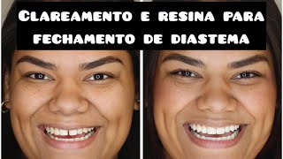 Clareamento e resina para o fechamento de diastema [upl. by Adnorrehs]