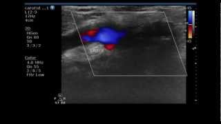 external carotid artery stenosis combined color Doppler ultrasound video [upl. by Nyrak]