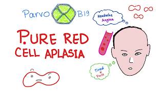 Pure Red Cell Aplasia PRCA  Parvo B19 Virus  Hematology [upl. by Yojenitsirk943]