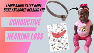 WHAT IS CONDUCTIVE HEARING LOSS  HOW DOES THE BAHA WORK LEARN ABOUT CALIS HEARING LOSS [upl. by Eirffej749]