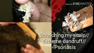 Scratching my scalp Extreme dandruff psoriasis [upl. by Shatzer693]