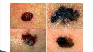 Cancerous moles and warts [upl. by Assenab]