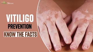 Vitiligo Disease Types Symptoms Causes Treatment and Recovery  What is Vitiligo Disease [upl. by Adkins]