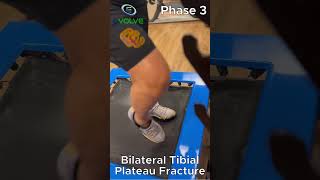 Bilateral Tibial Plateau Fractures Improving Strength and Stability With Jumping [upl. by Nalyak]