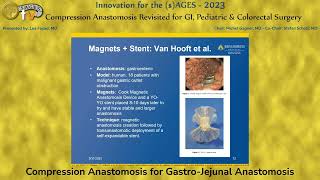 Compression Anastomosis for GastroJejunal Anastomosis [upl. by Anilac506]