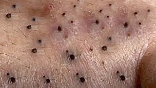 Blackheads Removal Big Acne blackheads Extraction Whiteheads [upl. by Avert937]