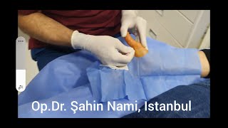 Ameliyatsız Tetik Parmak Tedavisi Percutaneous Trigger Finger Treatment [upl. by Katalin647]