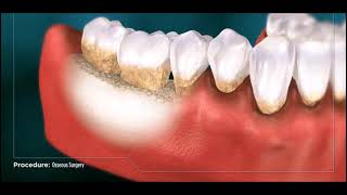 Osseous Recontouring Surgery [upl. by Oniratac203]