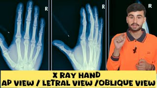 X Ray Hand  ap view  letral view amp oblique view [upl. by Ayikan]