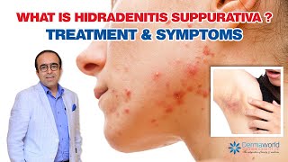 What is Hidradenitis Suppurativa  ¦ Treatment and Symptoms  Dr Rohit Batra [upl. by Rihana]