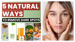 5 Natural Remedies to Remove Dark Spots on Your Face  Skin Care [upl. by Dyna]