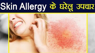 Skin Allergy Home Remediesबारबार Allergy से हैं परेशान तो अपनाएं ये घरेलू नुस्खे  Boldsky [upl. by Wystand168]