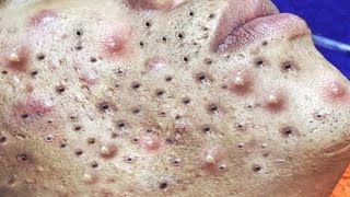 Big Cystic Acne Blackheads Extraction Blackheads amp Milia Whiteheads Removal Pimple Popping  5743 [upl. by Inahc]