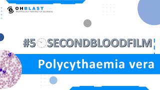 50SecondBloodFilm Polycythaemia vera [upl. by Daza]