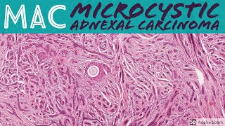 Microcystic Adnexal Carcinoma MAC 5Minute Pathology Pearls [upl. by Fitzsimmons]