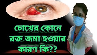 What is subconjunctival hemorrhage Causes amp Treatment in Bengali  in details [upl. by Ehlke]