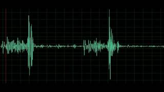 Ventricular Septal Defect after a Starflex device closure [upl. by Ocirred878]