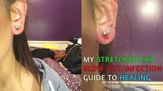 STRETCHED EAR BLOWOUT  HOW I HEALED MY EARS  Erika Anderson [upl. by Mauretta]