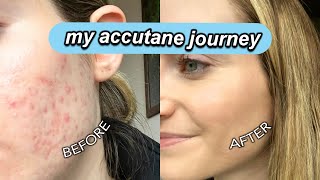 MY ACCUTANE JOURNEY  acne side effects results tips skincare everything you need to know [upl. by Gnoix]