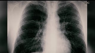 Prohibición para evitar más casos de silicosis En Australia es ley en California no hay planes [upl. by Toole295]