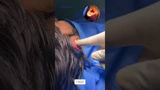 Otoplasty  Ear Correction  Cosmetico by Dr Kamal [upl. by Bennet]