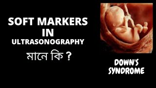 SOFT MARKERS IN ULTRASONOGRAPHY [upl. by Adnohsak471]