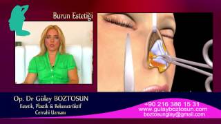 OpDrGülay BOZTOSUN quotBURUN ESTETİĞİ RHİNOPLASTYquot wwwdrgulayboztosuncom [upl. by Nairehs]