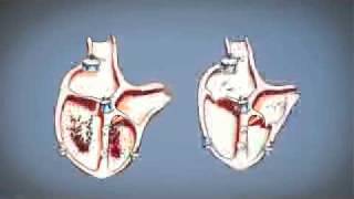 Arrêt cardio respiratoire  défibrillateur  arrêt cardiaque [upl. by Enaols]