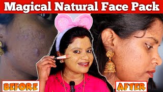 🔥Just👉 15 நிமிடத்தில் முகம் பளிச்சிடும் 🥰 Magical face pack to remove acne amp dark spot ❤ [upl. by Swen365]