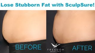 Dianas SculpSure Journey  SHOCKING Before amp After [upl. by Hazrit]