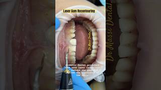 Laser Gum Recontouring oralhealth youtubeshorts dentist smile gummy gummysmile shorts [upl. by Asilak]