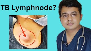 TB Lymphnode Symptoms Diagnosis amp Treatment Tuberculous lymphadeniyis [upl. by Krishna]