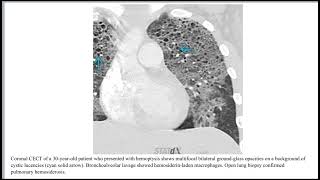 Idiopathic Pulmonary Hemosiderosis [upl. by Beckerman]