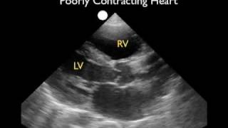 Cardiac Ultrasound  Parasternal Long Axis  Part 2  SonoSite Inc [upl. by Irak]