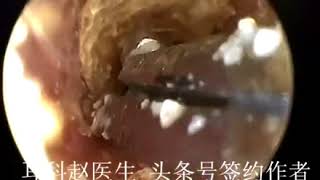 Earwax Removal Extractions By Tweezers 这一期用钳子夹片片 外耳道耳屎清理 耳垢 耳垢 [upl. by Mathia]