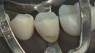 Class V Composite Preparation amp Restoration  Operative Dentistry [upl. by Adlaremse]