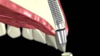 3D Medical Animation of a Dental Implant [upl. by Llebyram193]