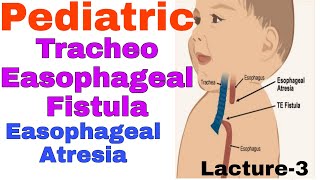 Tracheoesophageal fistula in hindiEsophageal Atresia  TEF EA  staff nurse online classes [upl. by Suiratnod]