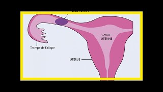 Qu’estce qu’une grossesse extrautérine   26032018 [upl. by Halsey]