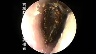 Earwax Removal Extractions Black Huge Earwax Take out after Soften 大黑硬菜软化后取出 外耳道挖耳屎清理 耳垢 [upl. by Mark]