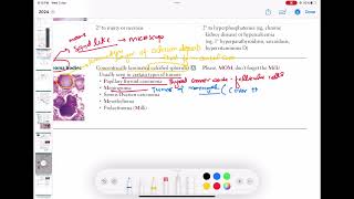 psammoma bodies Pathology 19  First Aid USMLE Step 1 in UrduHindi [upl. by Ternan]